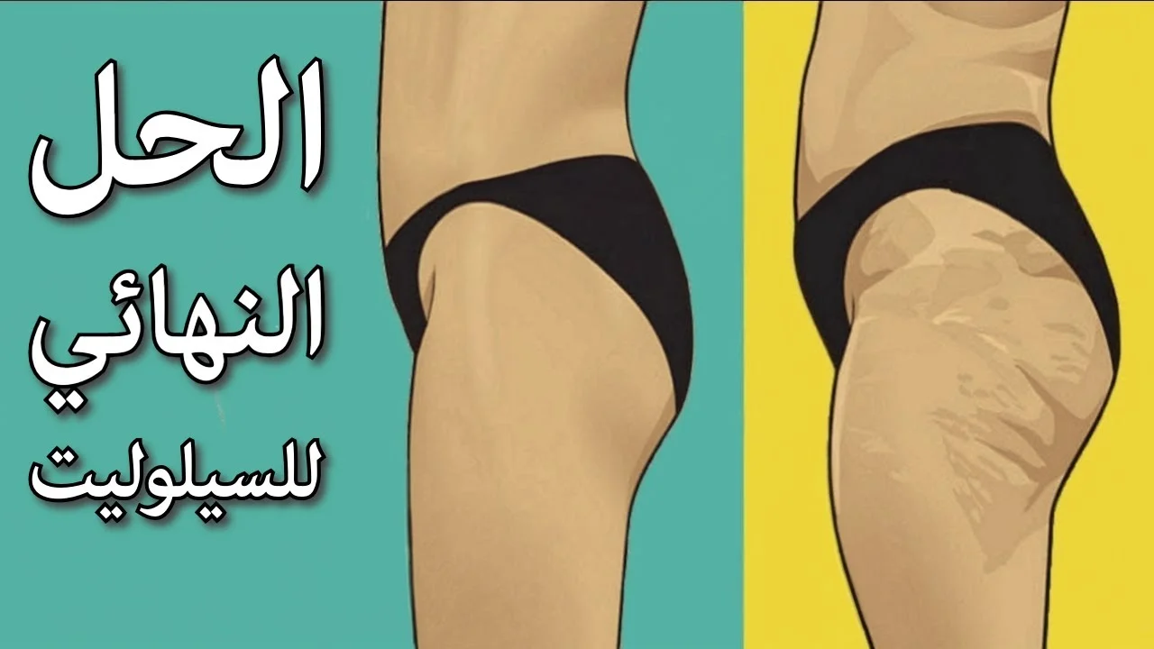 علاج السيلوليت عند النساء